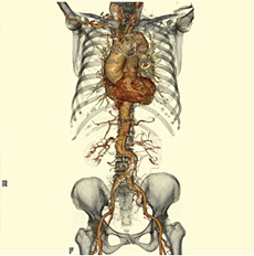 胸・腹部大動脈ＶＲ画像