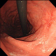 胃潰瘍瘢痕