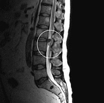 脊髄腫瘍（腰椎）